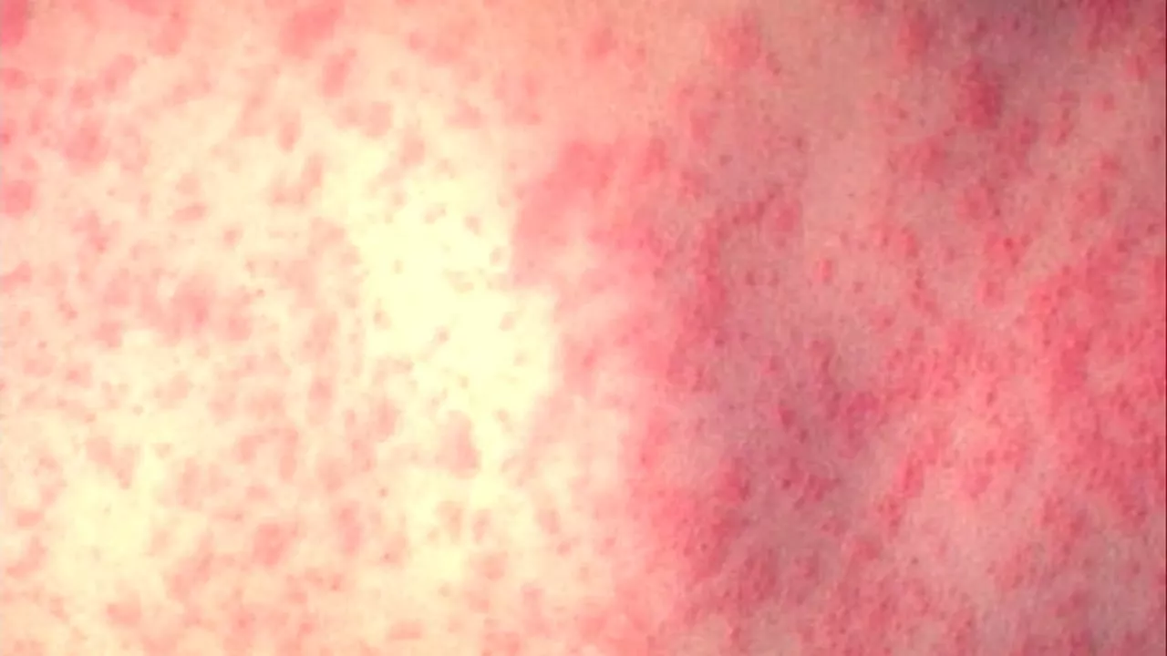 Alameda Co. issues warning after possible measles exposure at San Leandro restaurant