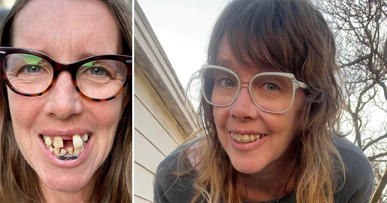 Woman with crooked 'shark' teeth finally gets her perfect smile