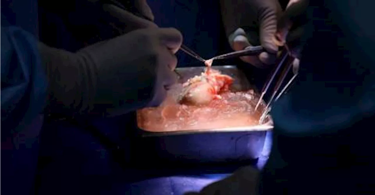 US surgeons transplant pig kidney to live patient in world first