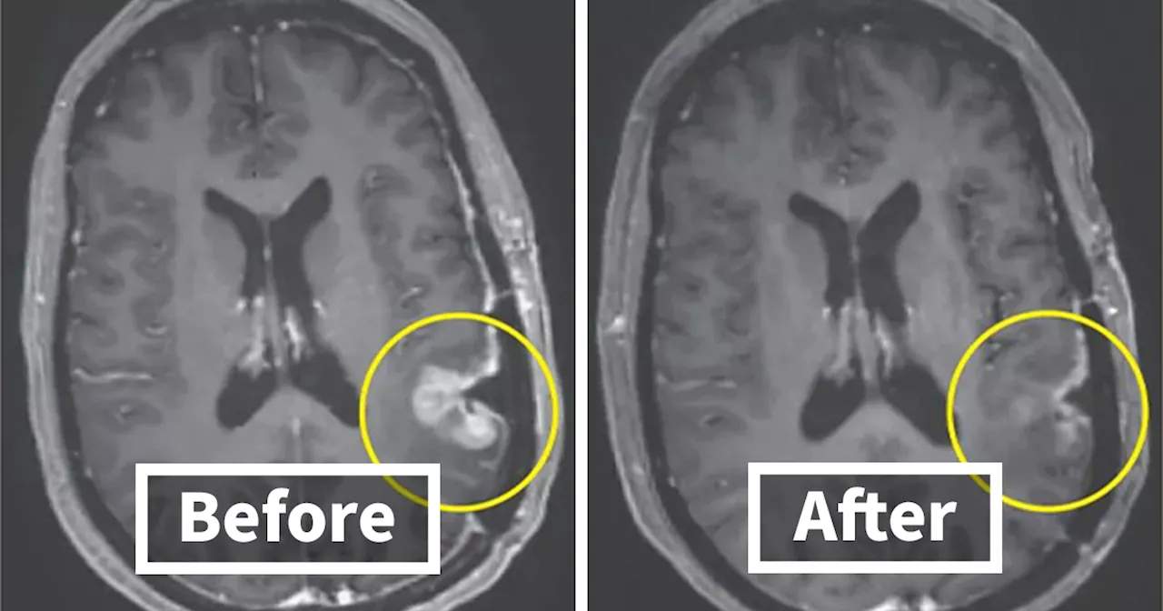 Glioblastoma Patient Sees Tumor Almost Disappear In Days Thanks To New Breakthrough