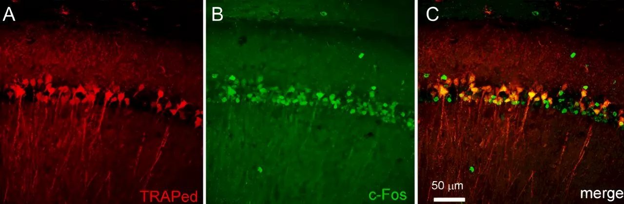 Intervention after first seizure may prevent long-term epilepsy