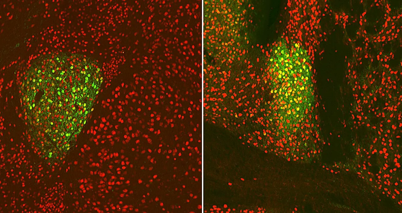 Scientists pinpoint anorexia's neurologic origins