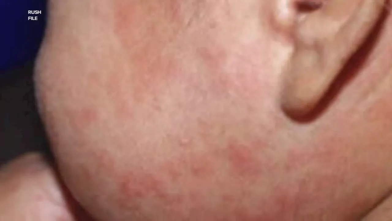 Chicago reports 2 more measles cases, bringing total to 17