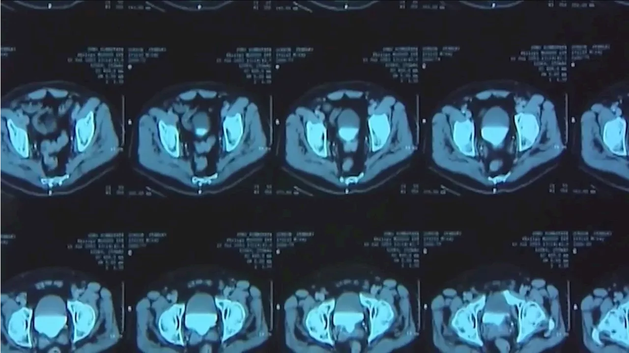 National trend shows increasing amount of people under 50 are diagnosed with cancer