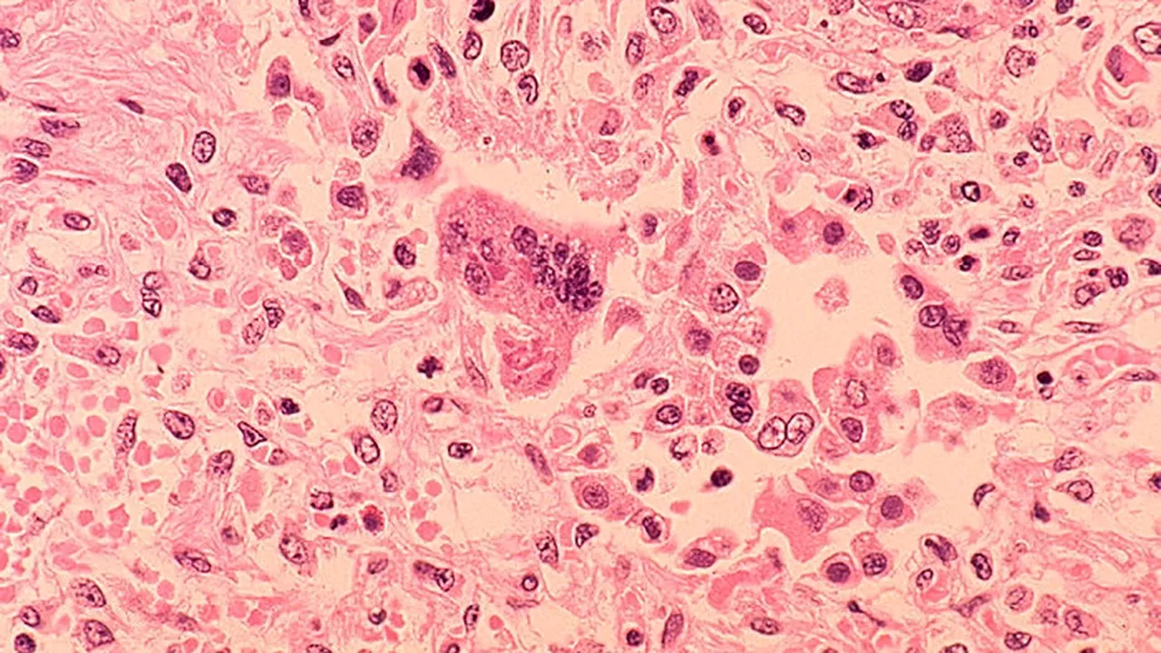 Nassau County reports first measles case this year; third in New York