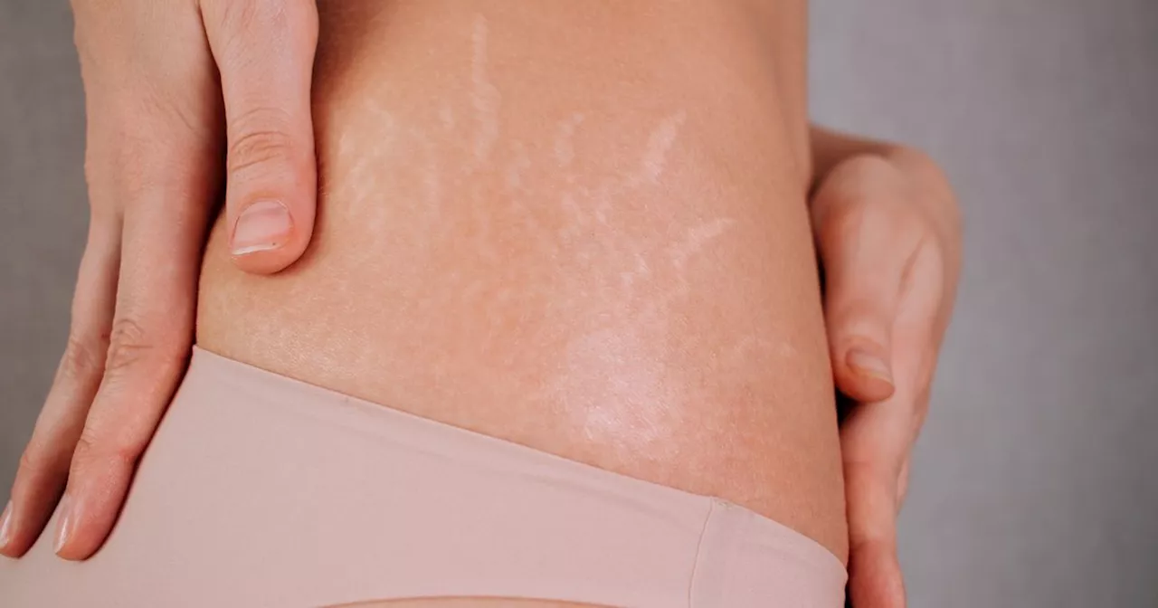 Amazon's £16 skin oil which 'works miracles' on stretch marks