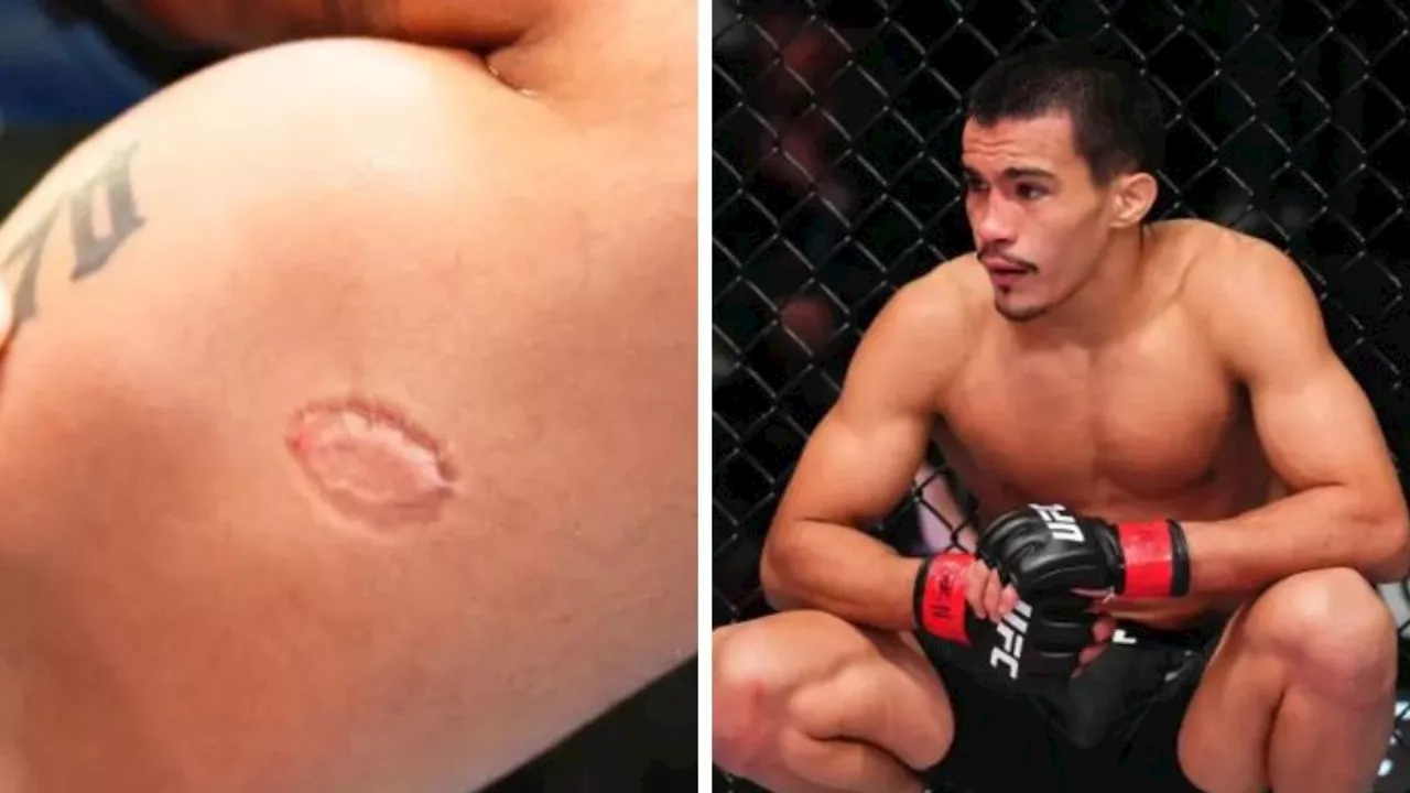 UFC fighter sacked over horror bite