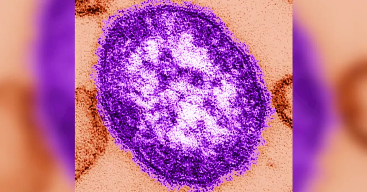 Measles cases in Chicago, 2 suburban counties have State of Illinois taking action