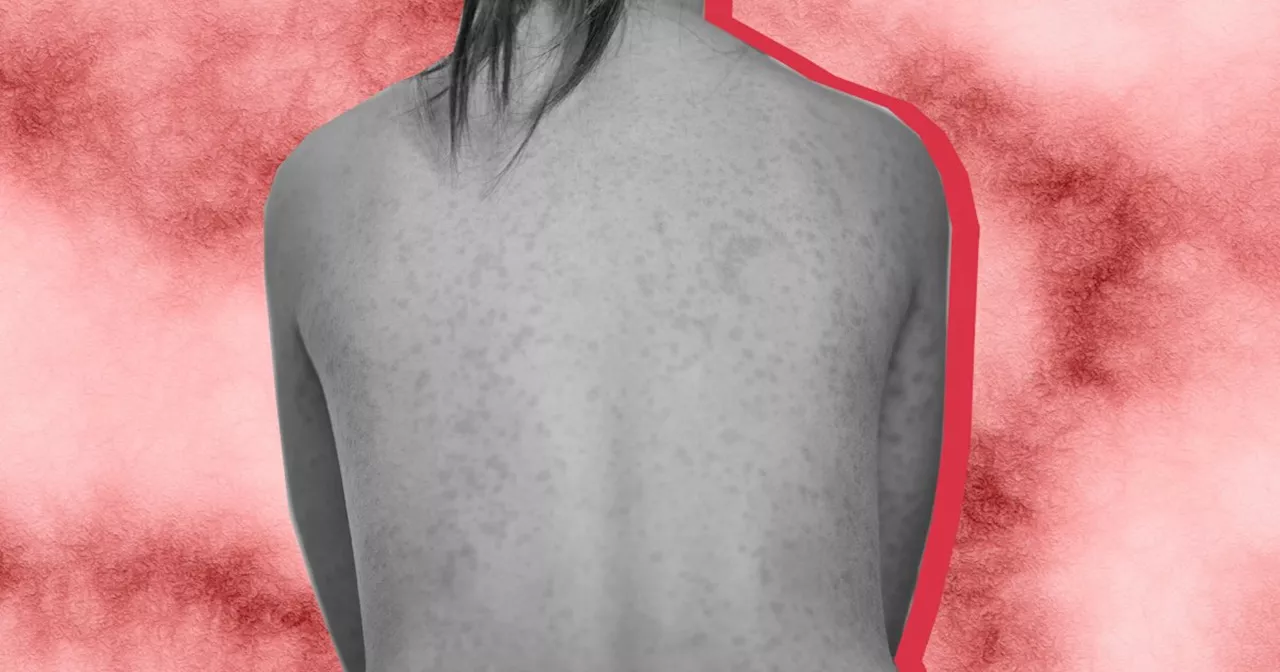 Le red skin syndrome, ou quand l'utilisation de corticoïdes met la peau en feu