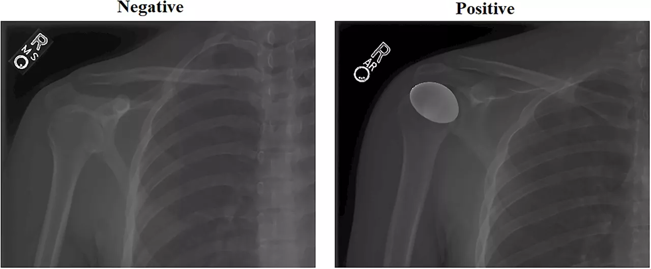 Deep learning enables faster, more accurate decisions for treatment of shoulder abnormalities