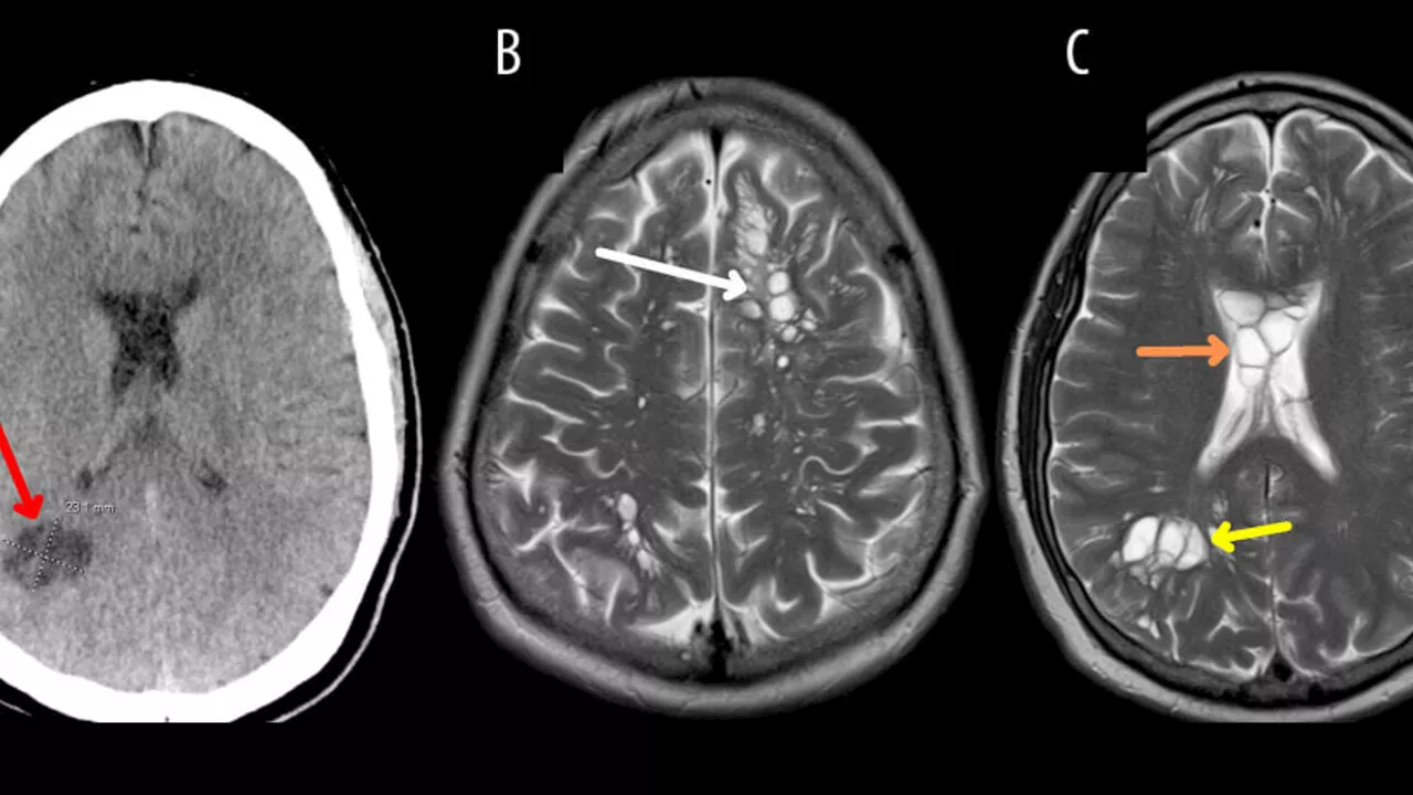 Vive con vermi nel cervello, scambiati per emicrania: aveva mangiato pancetta poco cotta