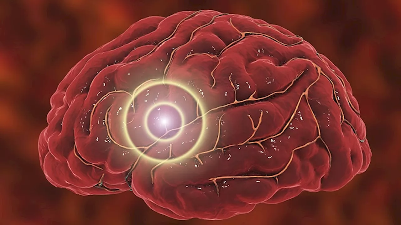 Hemorrhagic Stroke a Key Driver of Spike in US Stroke Rates