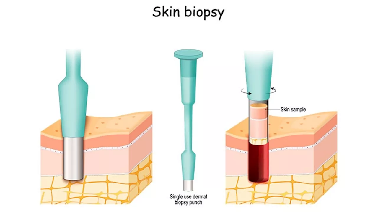 Skin Test Accurately Detects Parkinson's, Other Neurodegenerative Disorders