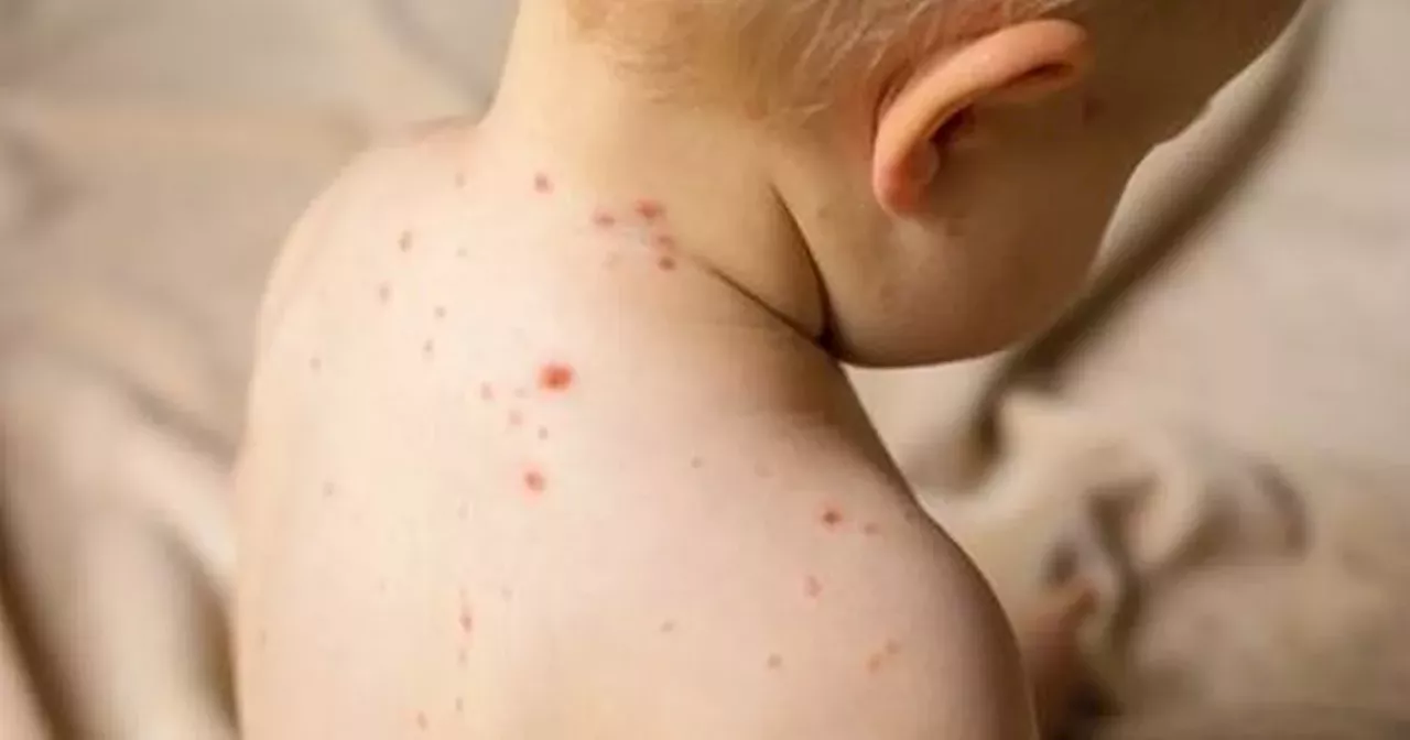 Police issue warning over 'childhood infection rising dramatically'