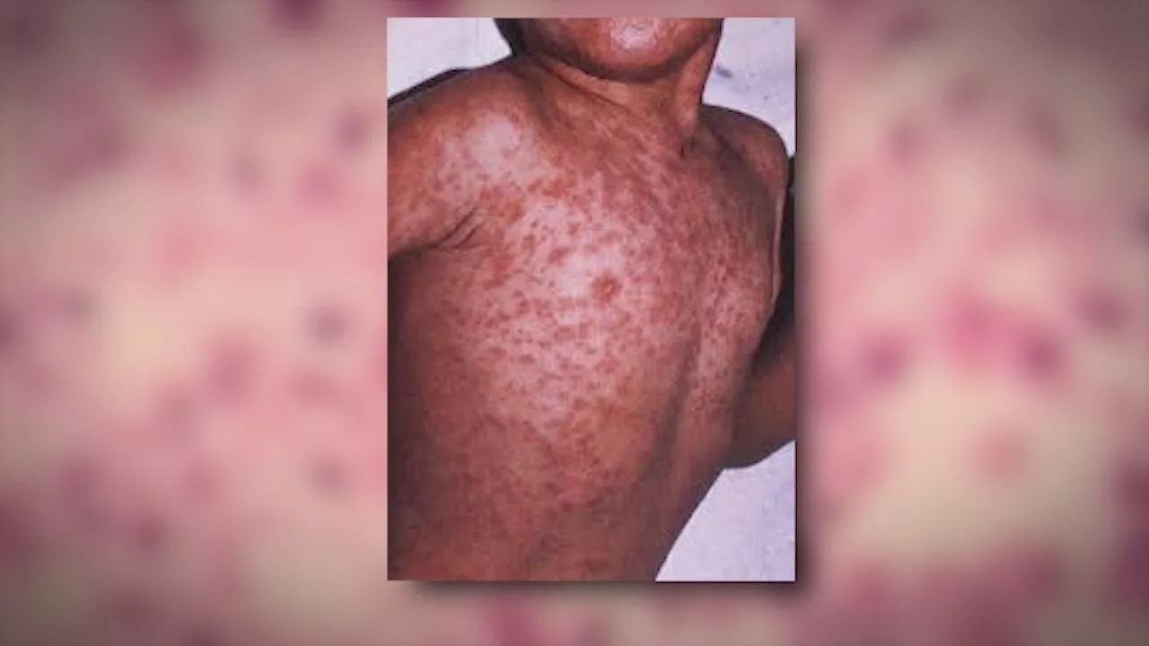 5 additional measles cases bring Chicago's outbreak total to 31