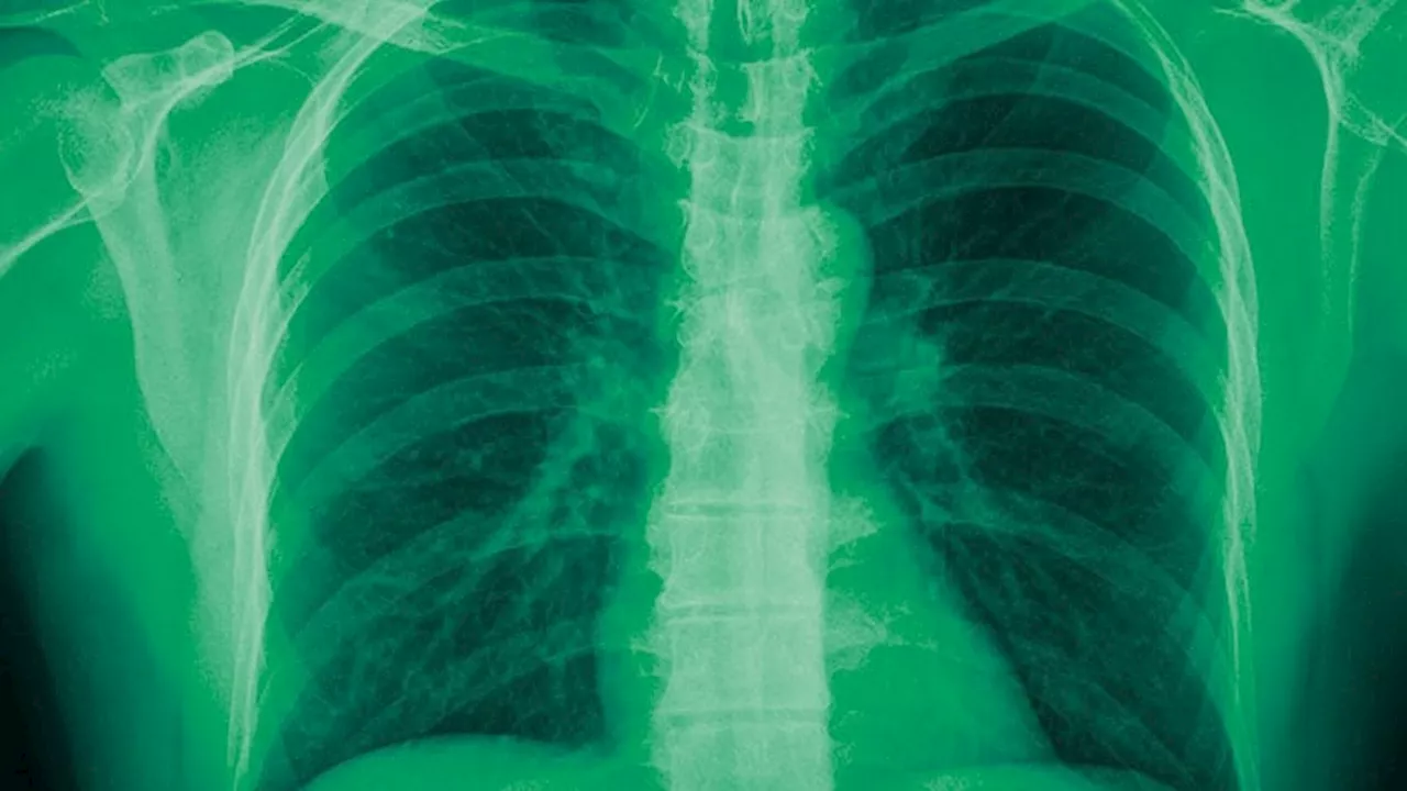 EPR and CRP Predict Adverse Events in COPD Exacerbations