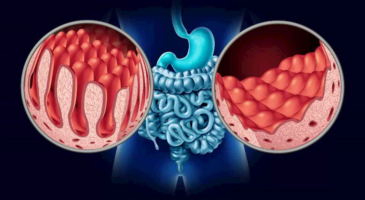 Celiachia: Attenzione a Questi Sintomi per una Diagnosi Precoce