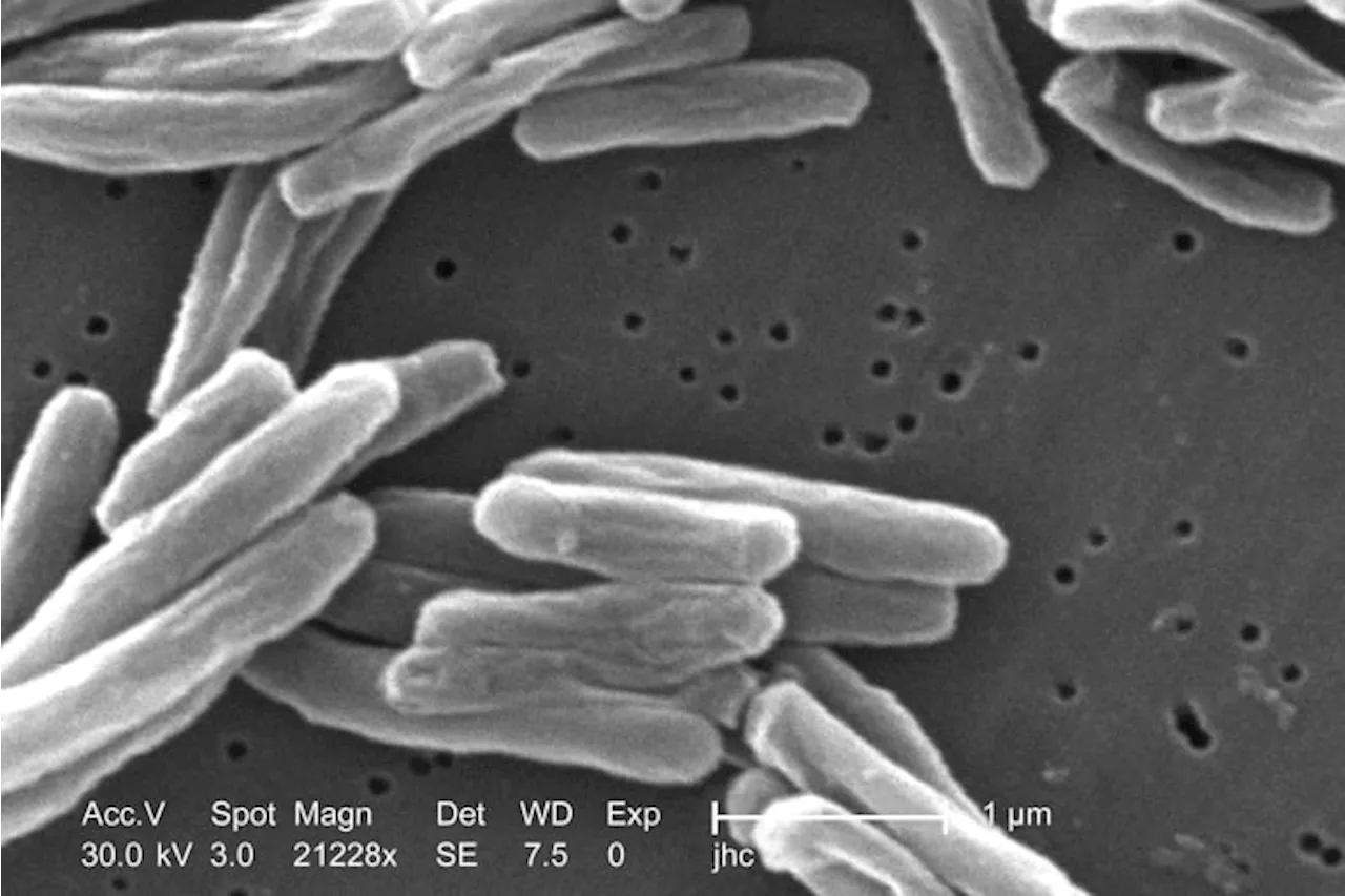 US tuberculosis cases were at their the highest level in a decade in 2023