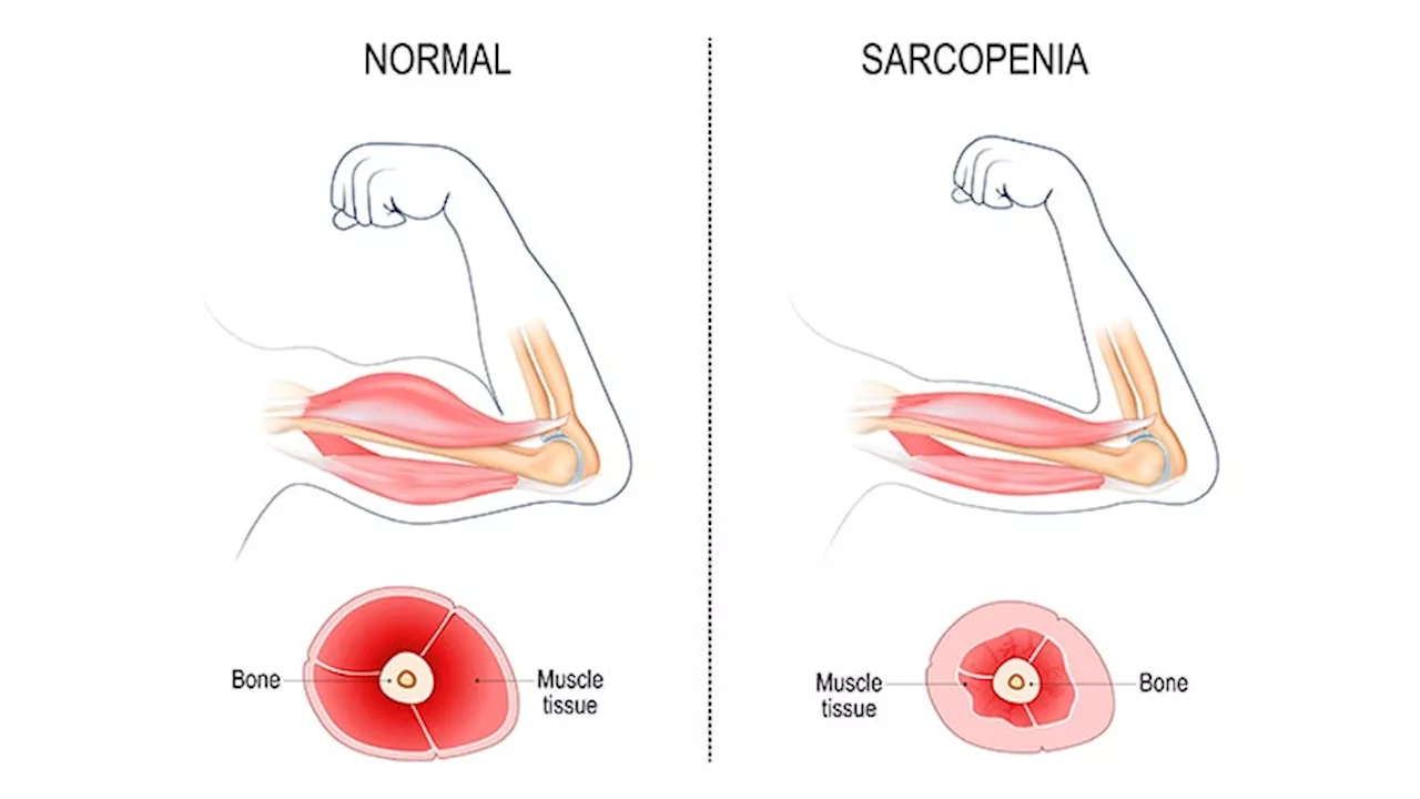 Combined Sarcopenia and Obesity Increase Risk for Death