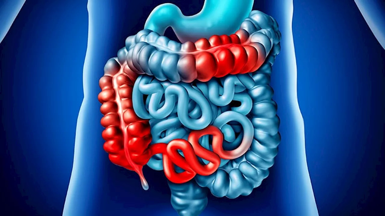 Perianal Fistulizing Crohn's Disease: Are Outcomes Better With Combined Medical-Surgical Treatment?