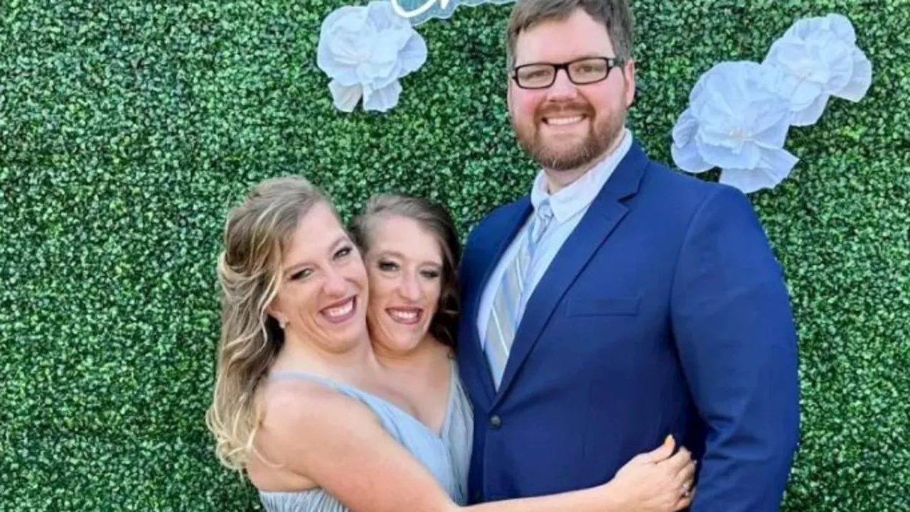 Famous conjoined twin marries boyfriend