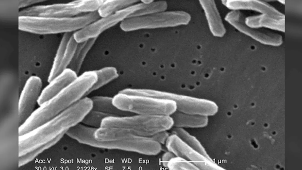 US tuberculosis cases were at the highest level in a decade in 2023