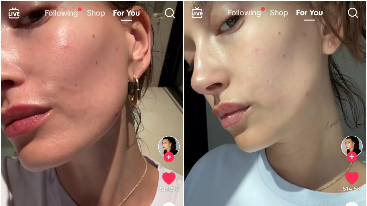 Hailey Bieber Shared Her 3-Step Skin Care Routine During a Perioral Dermatitis Flare Up