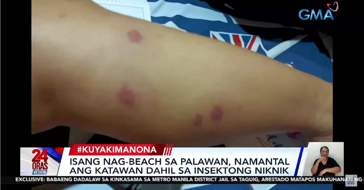 What should you do if you get bitten by niknik? Kuya Kim answers