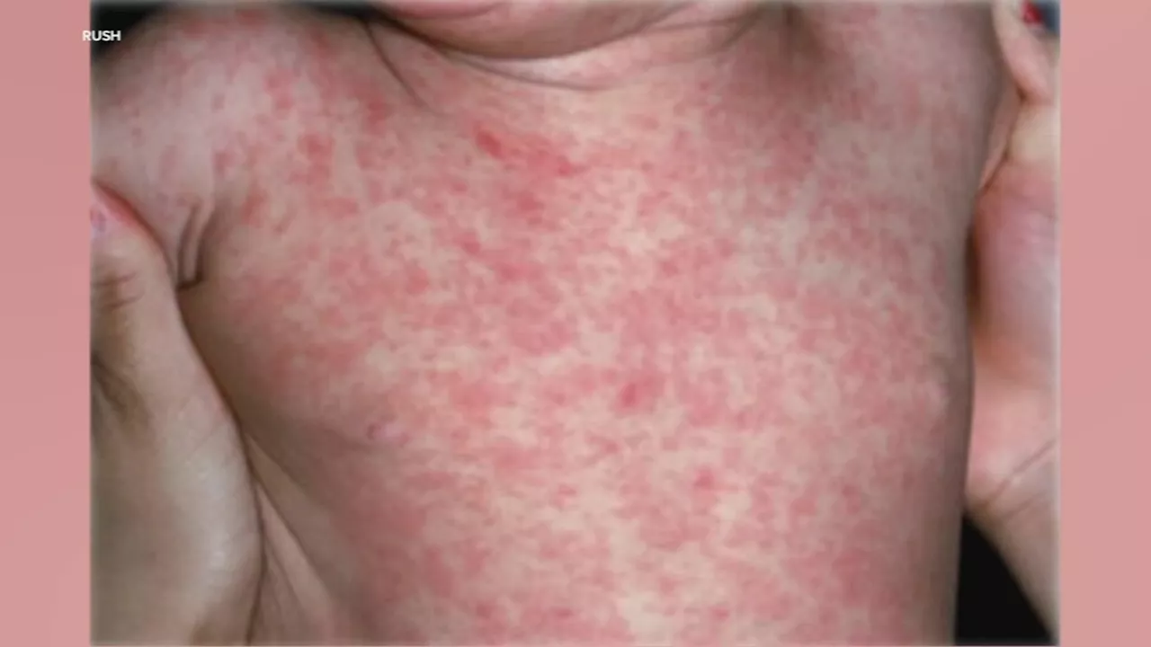 Chicago measles case confirmed, first since 2019; possible exposure at 2 locations in February