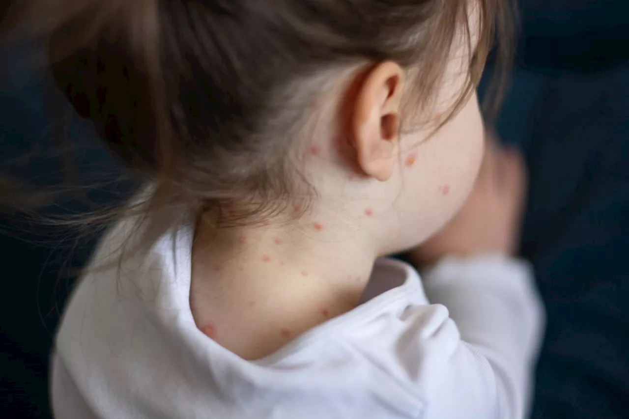 Measles Cases Prompt Canadians to Check Vaccination Status