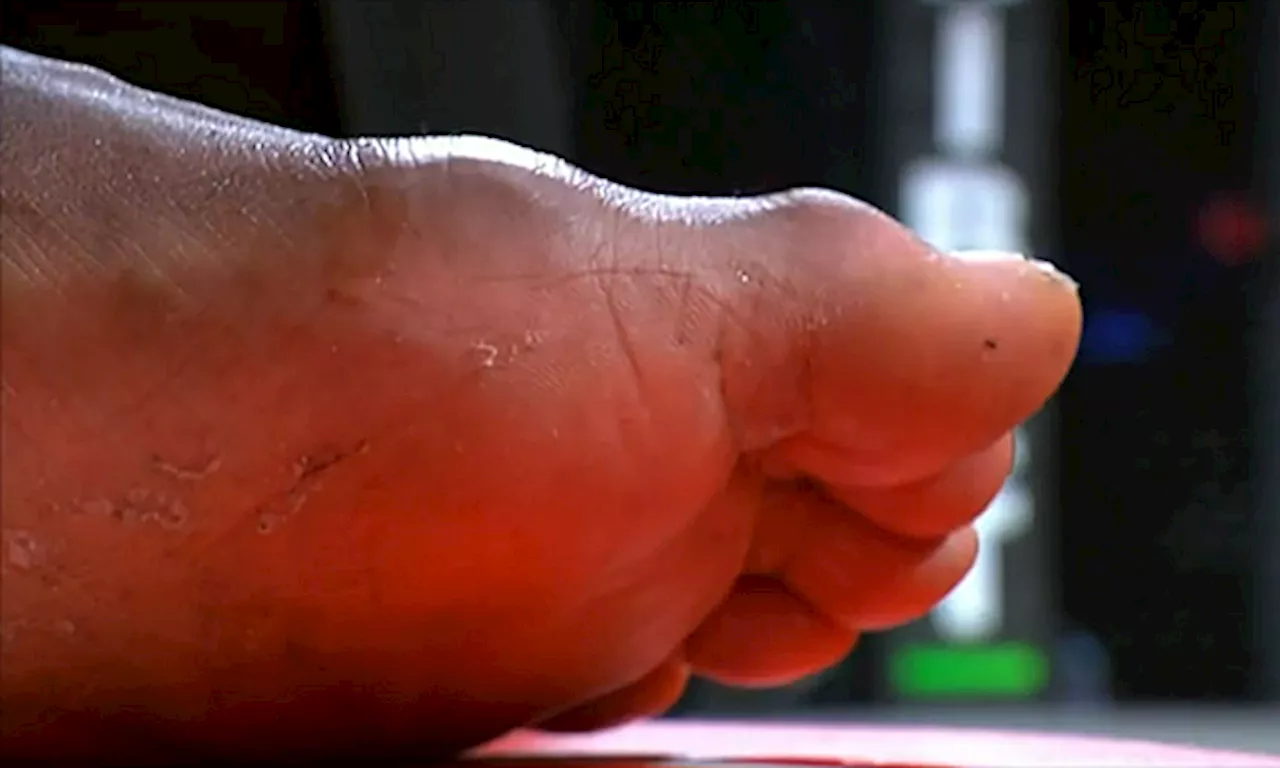 Referee Stops Bout Due to Fighter's Injured Foot