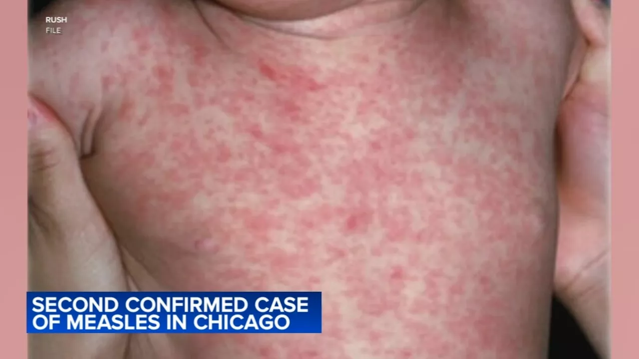 Child at Pilsen migrant shelter diagnosed with measles in second Chicago case in 24 hours, CDPH says