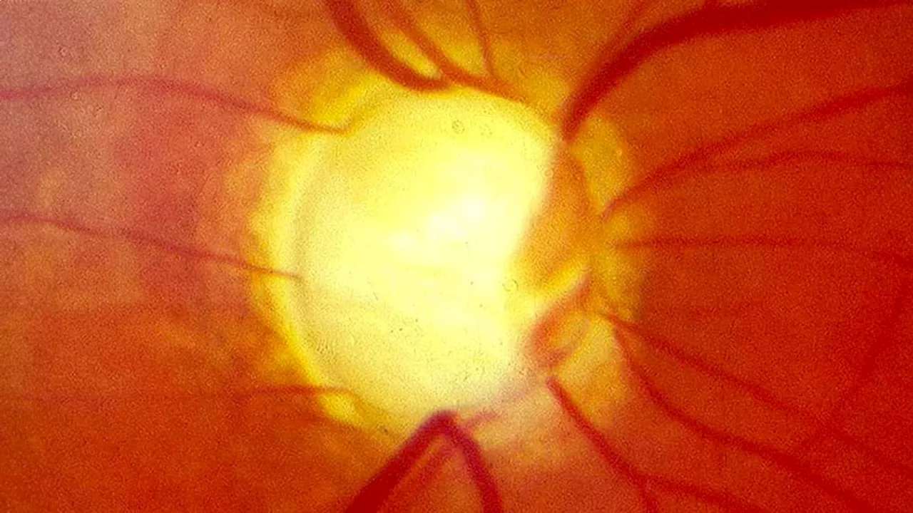 A Better Way to Assess Glaucoma?