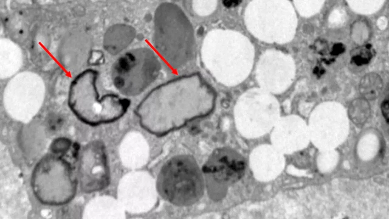 Le microplastiche nelle arterie umane: rischio raddoppiato di infarto e ictus