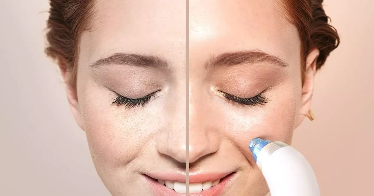 Amazon shoppers 'amazed' by £20 gadget that removes blackheads