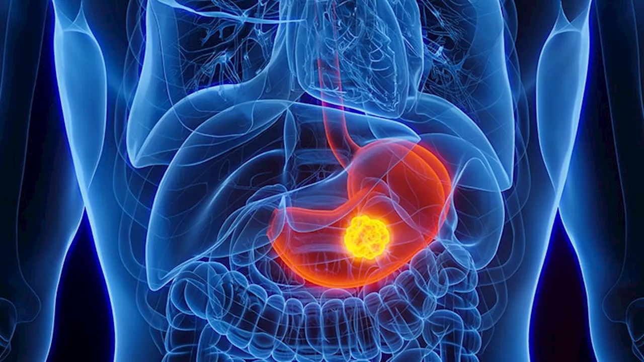 Combo Therapy Prolongs Survival in Patients With Gastric Cancer