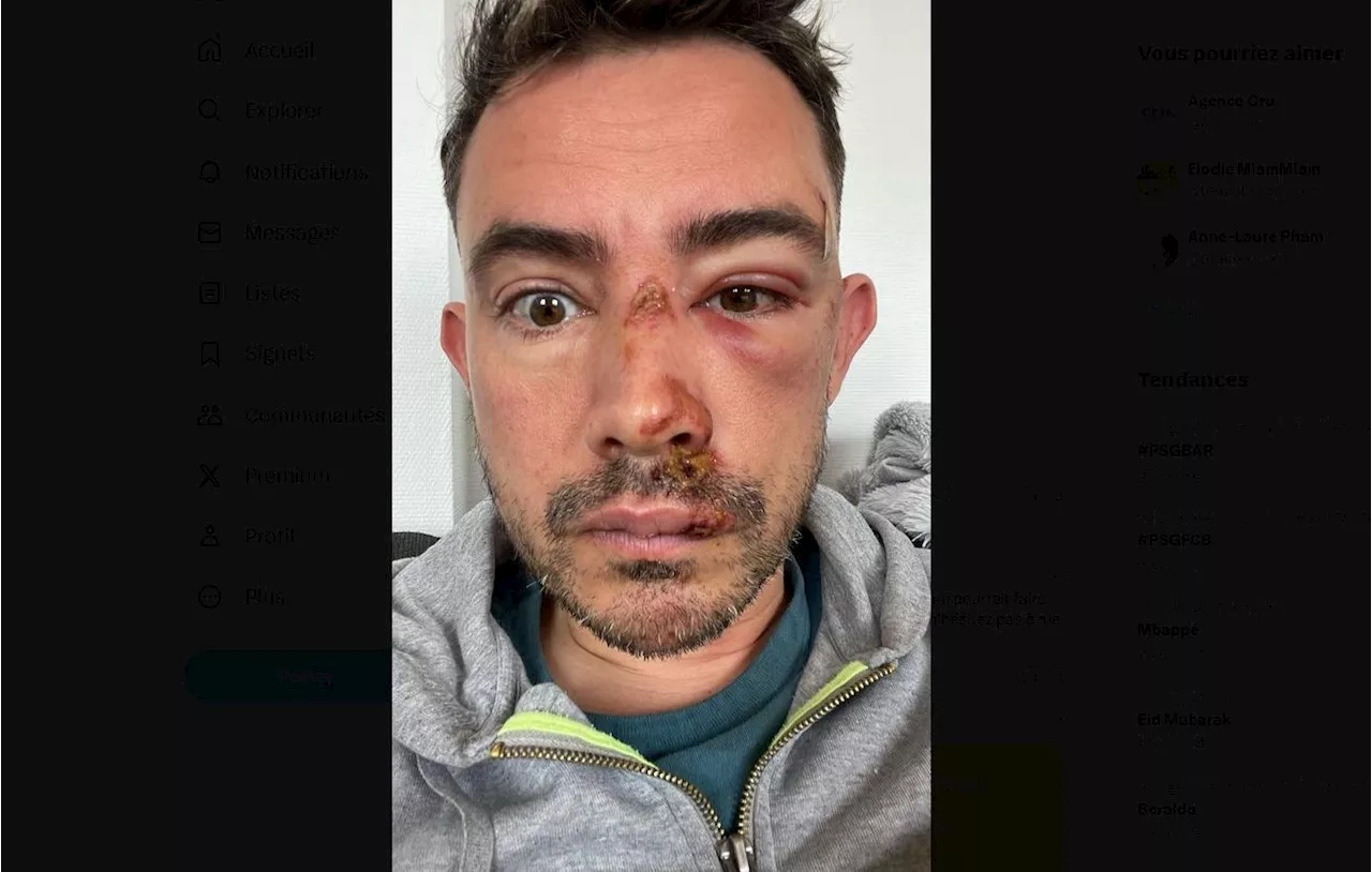 Lyon : « Un homme nous a défoncé le crâne et le visage »… Deux hommes victimes d’une violente agression homophobe