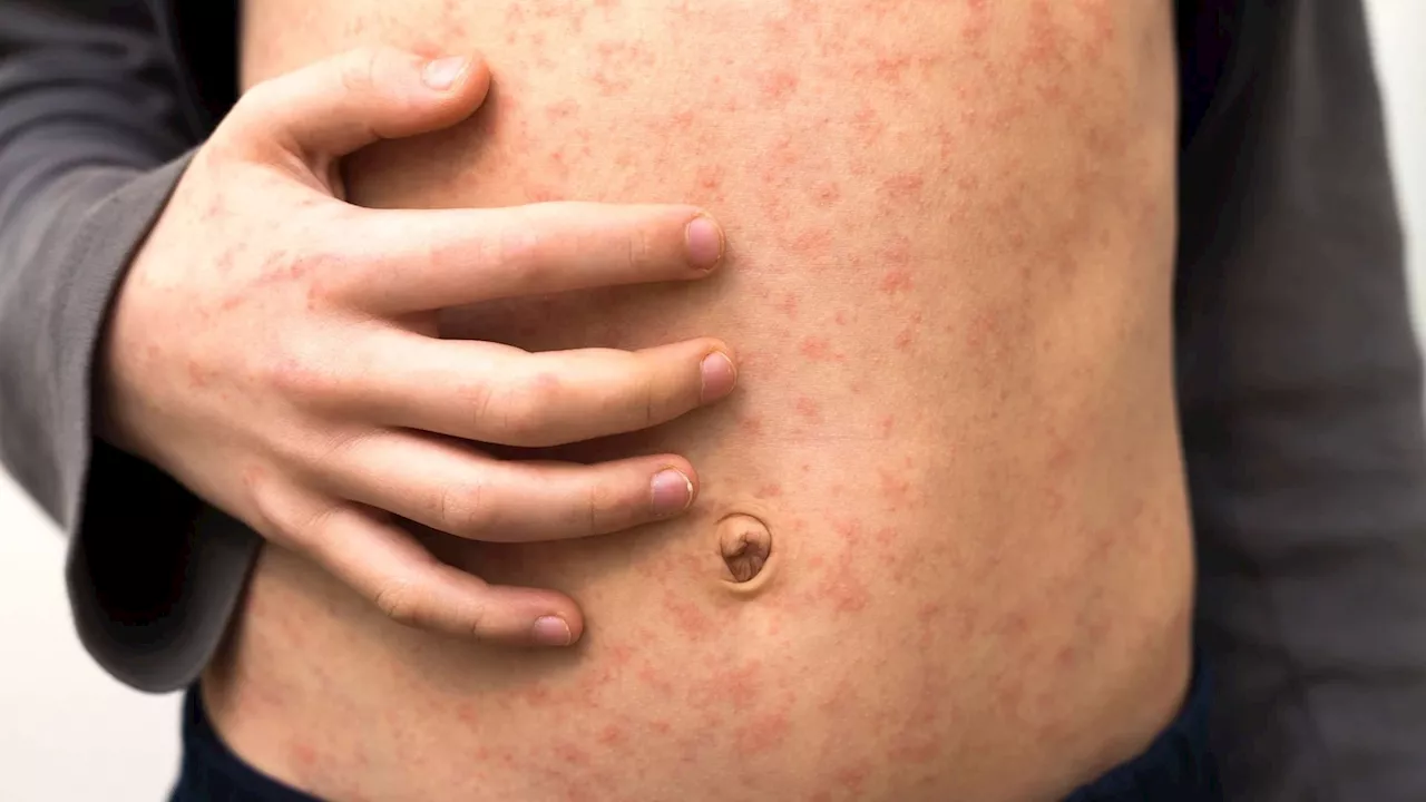 US measles elimination status threatened due to 2024 outbreak: CDC report