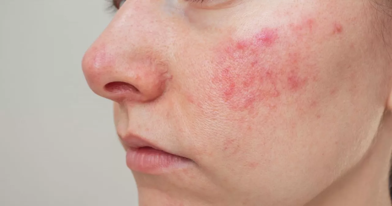 Skin experts highlight the early signs and red flag symptoms of rosacea