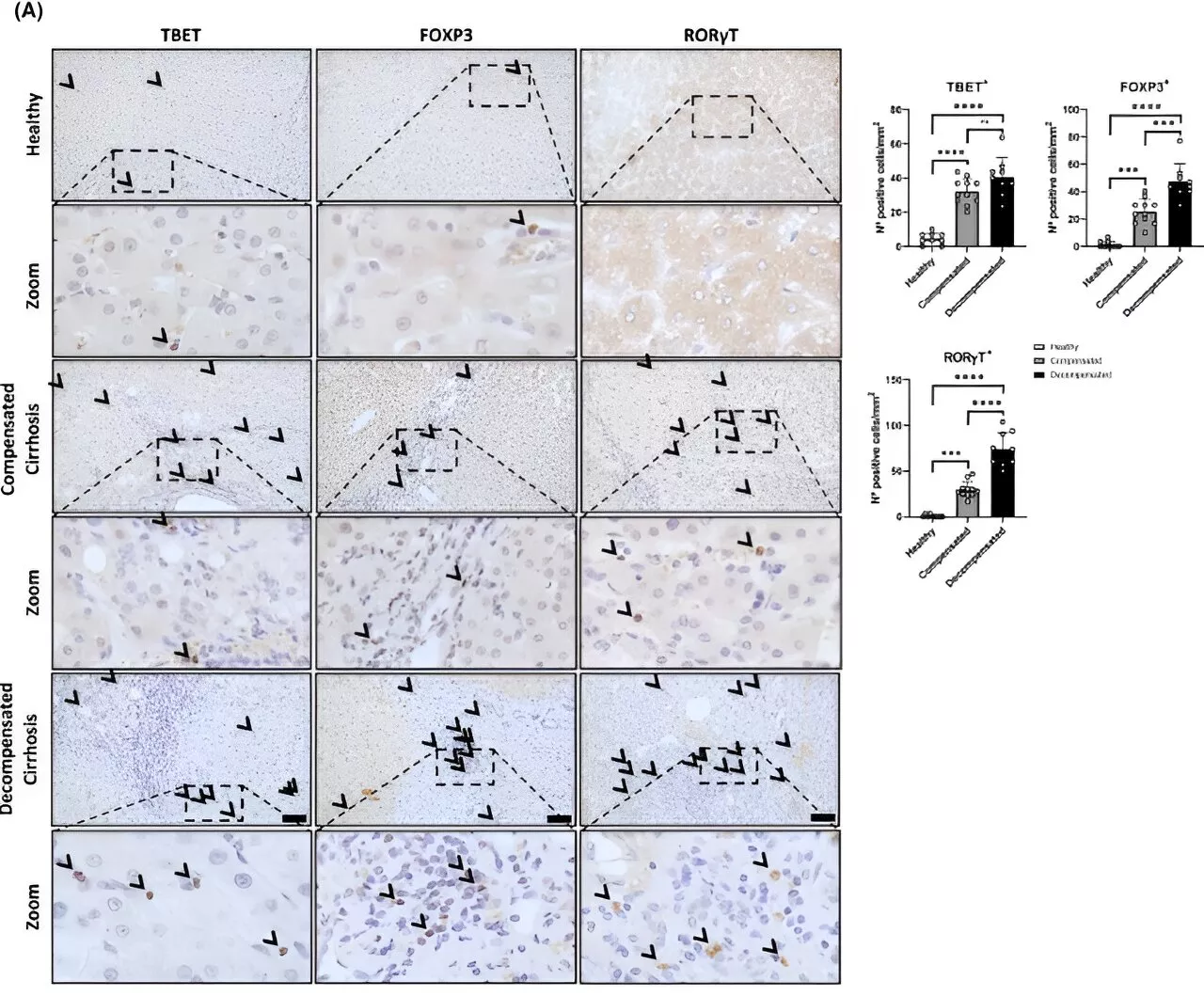 Study advances understanding of liver immune response in cirrhosis