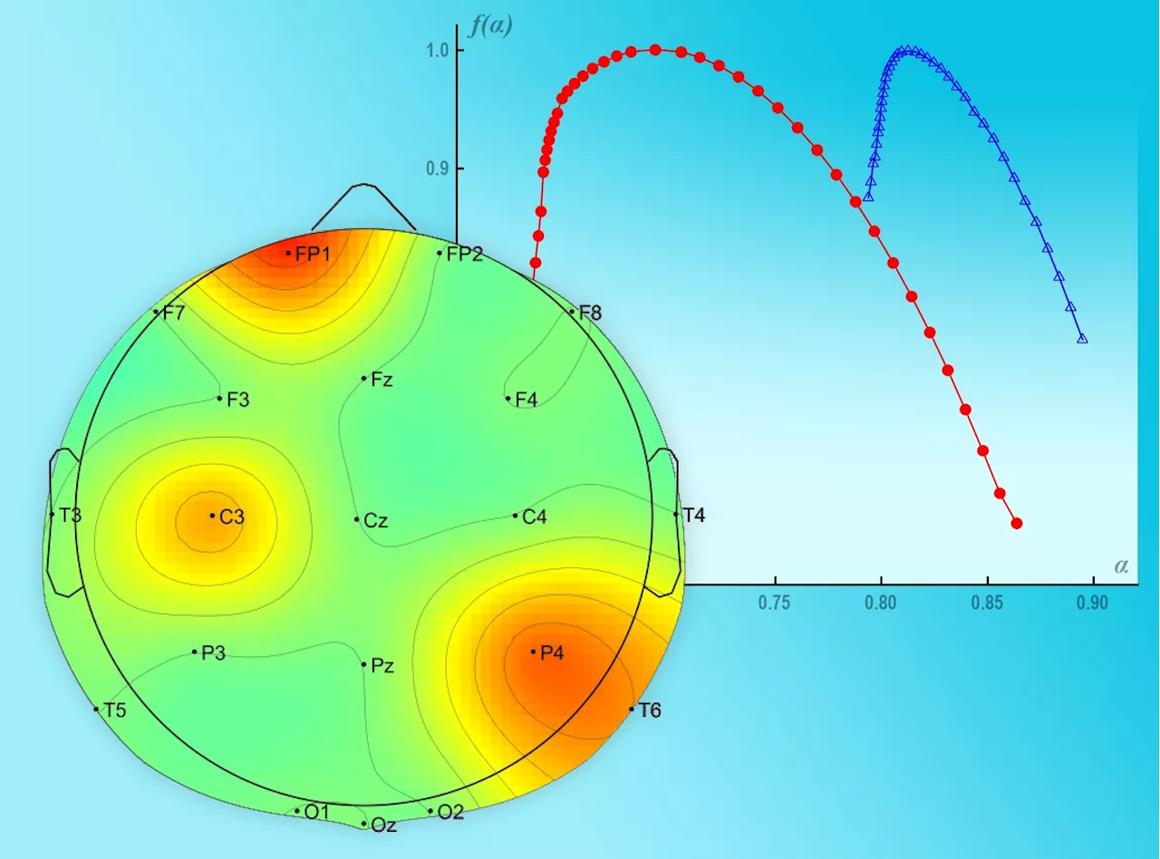 Team reports on multifractal detection of the early stages of multiple sclerosis