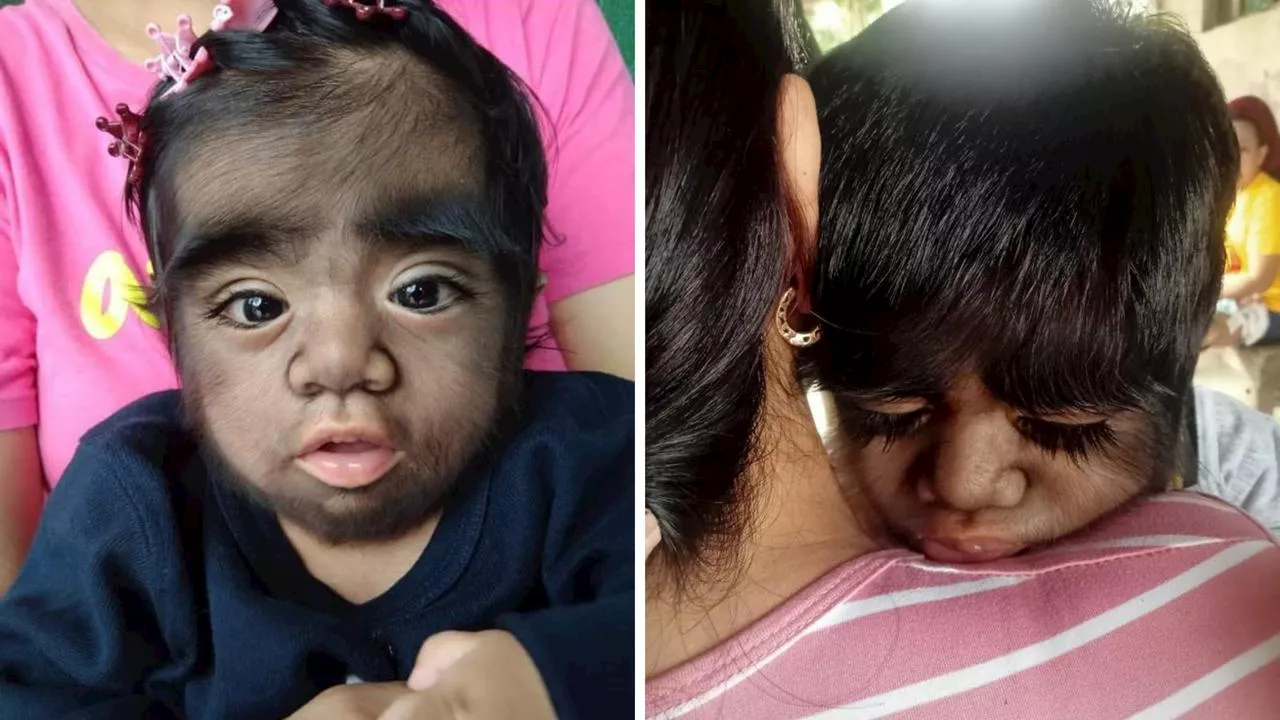 2yo has one-in-a-billion ‘werewolf syndrome’