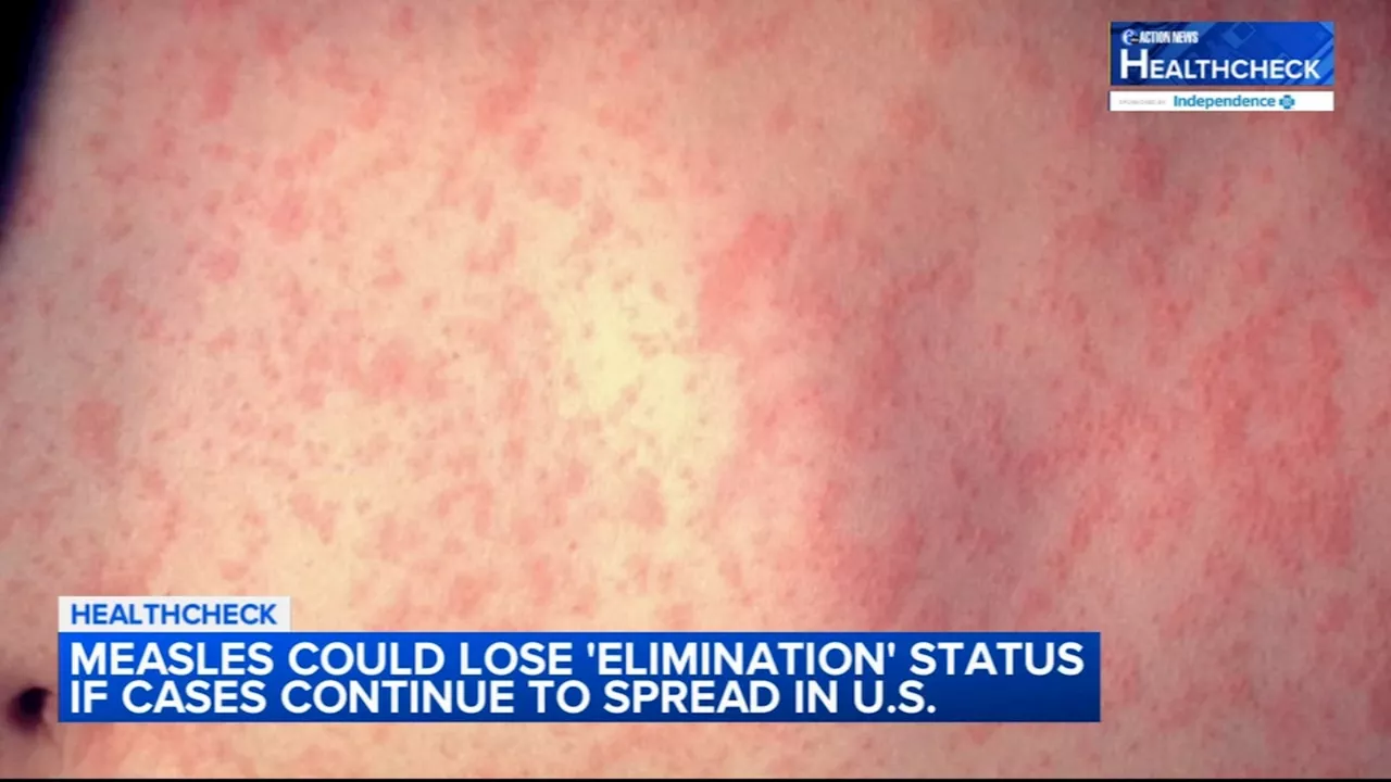 Measles outbreak slowing in Chicago after over 50 cases reported in less than 1 month