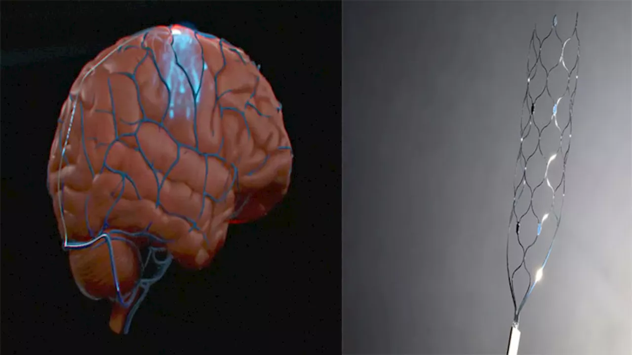 Synchron, a rival to Musk's Neuralink, readies large-scale brain implant trial