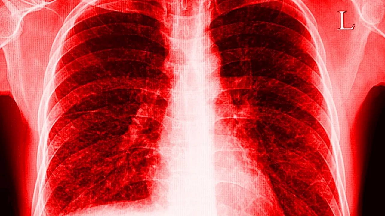 High Infection Risk in Rheumatoid Arthritis–Associated Interstitial Lung Disease