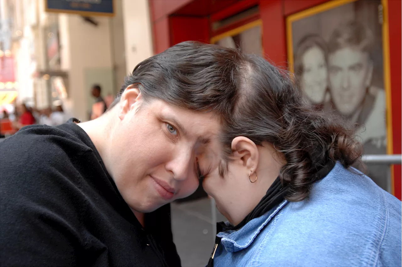 World's oldest conjoined twins, Lori and George Schappell, die at age 62