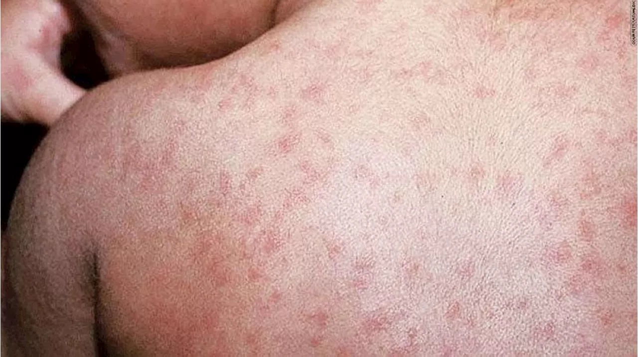 DOH not concerned about measles outbreak spreading to other regions