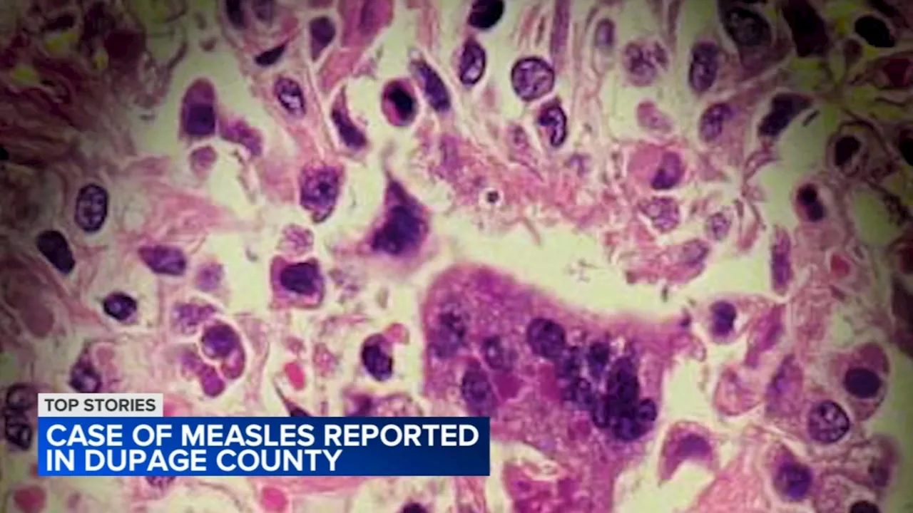 1st case of measles reported in DuPage County since 2009, health officials say