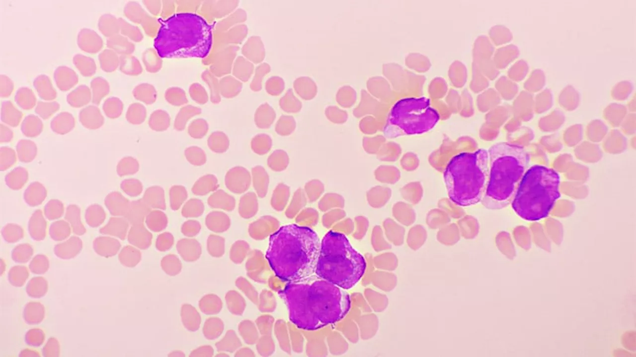 Comparing Bispecific Antibodies and CAR T-Cell Therapy for Relapsed/Refractory ALL