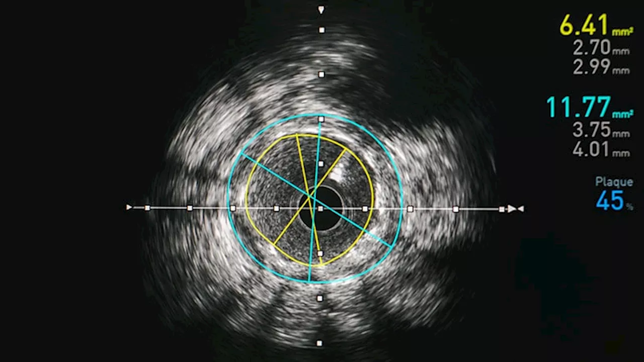 IVUS Bests Angiography to Guide PCI in ACS